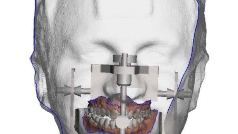 Cirugía guiada y asistida por ordenador2