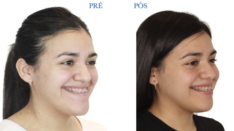 cirugía ortognática mínimamente invasiva