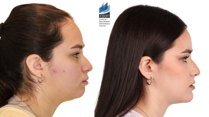 cirugía ortognática