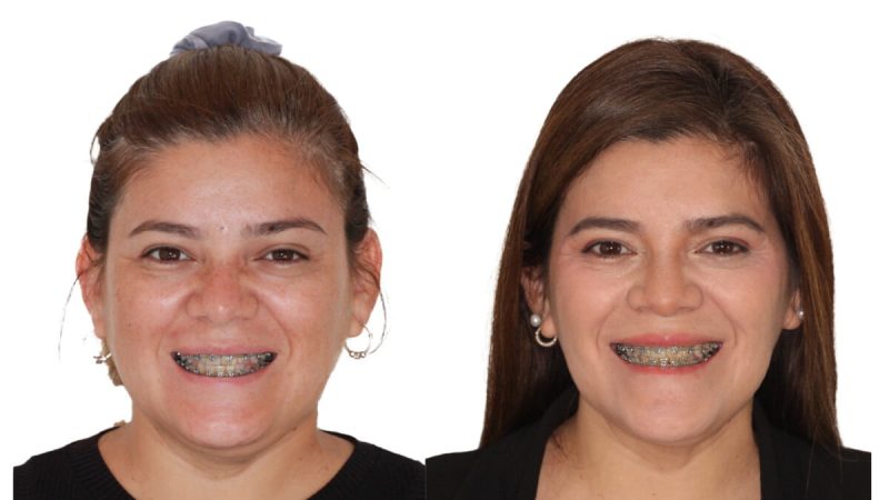 cirugía ortognática mínimamente invasiva