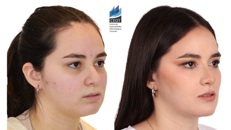 cirugía ortognática