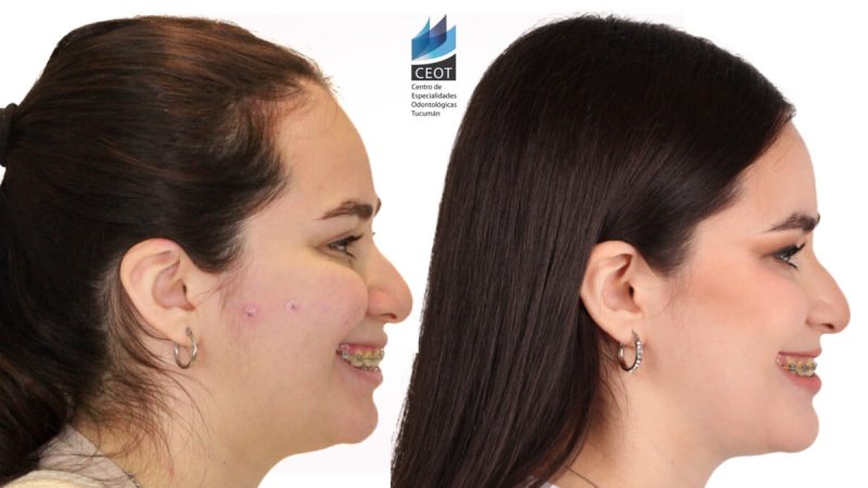 cirugía ortognática